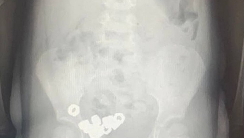 В Воронеже трехлетний мальчик проглотил стальных 16 гаек