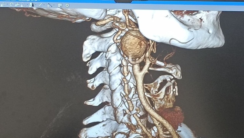 Челябинские медики спасли пациентку с гигантской аневризмой сонной артерии